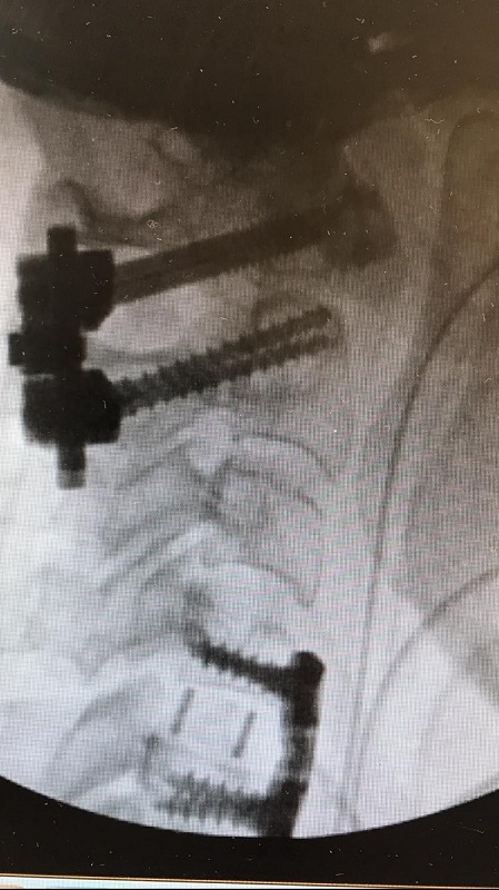 צילום רנטגן של עמוד השדרה הצווארי לאחר שני הניתוחים המורכבים בקפלן