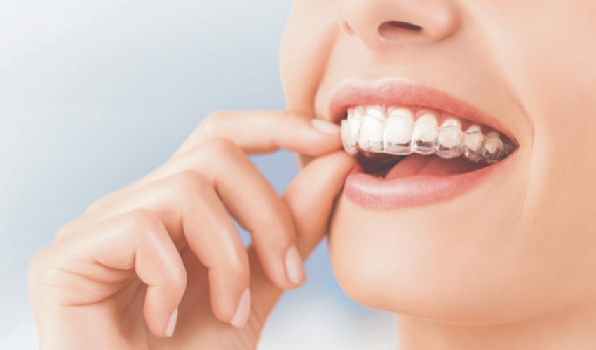 יישור שיניים באמצעות קשתיות שקופות (צילום: שאטרסטוק)